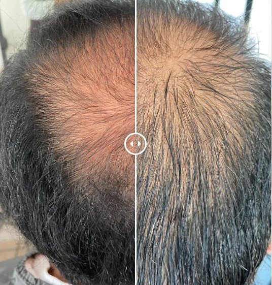 Tratamiento Alopecia – Anti-caída